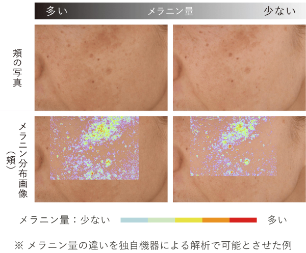 頬の写真 メラニン分布画像（頬） ※メラニン量の違いを独自機器による解析で可能とさせた例